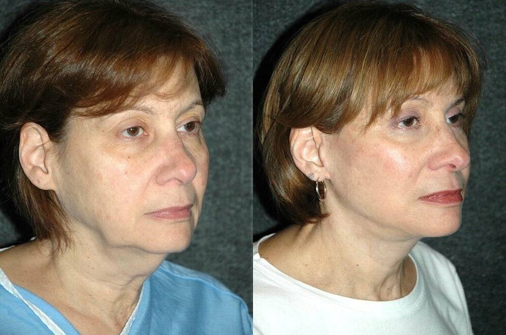 Лазерная подтяжка лица: фото кожи до и после шлифовки