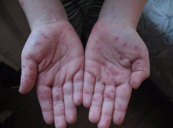 Что такое вирусный дерматит и как с ним бороться
