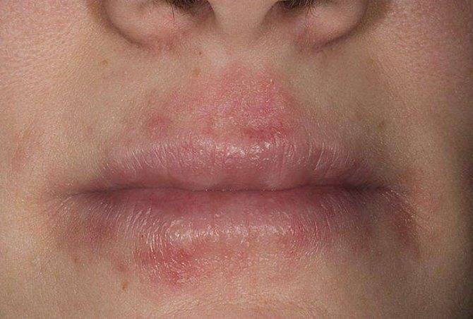 Пероральный дерматит на лице - лечение фото у детей и взрослых. причины и лечение перорального дерматита мазями