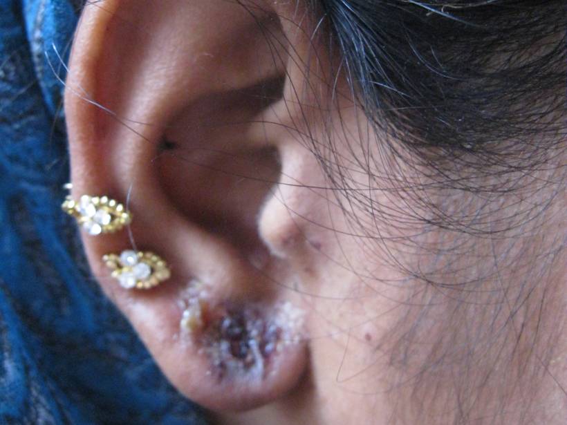 Образование перхоти в ушах: причины, симптомы, лечение