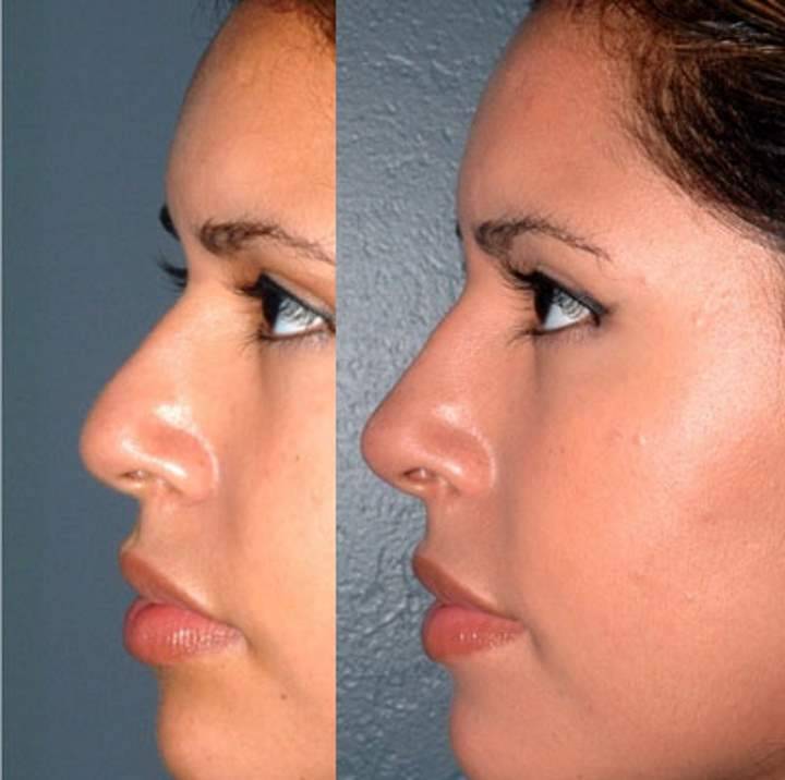 Контурная ринопластика носа