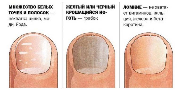 Болезни ногтей: причины деформации и изменения цвета ногтей – напоправку