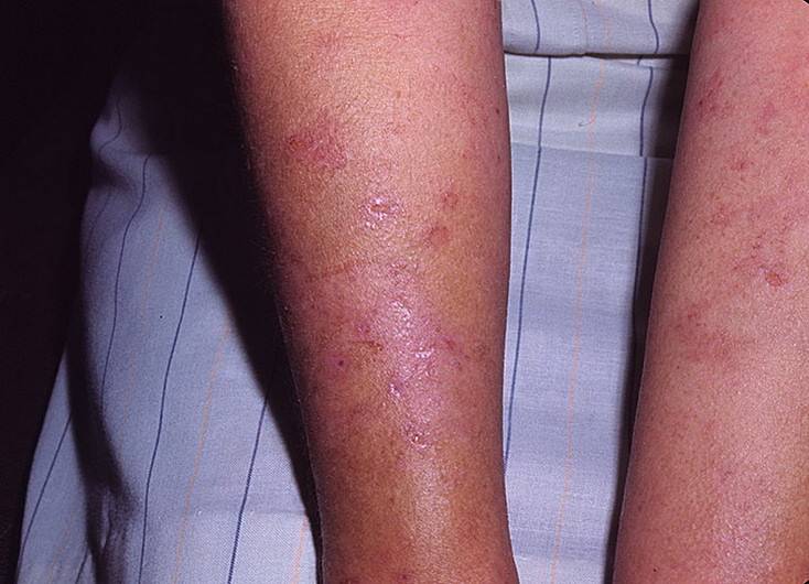 Герпетиформный дерматит дюринга: симптомы, лечение, диагностика