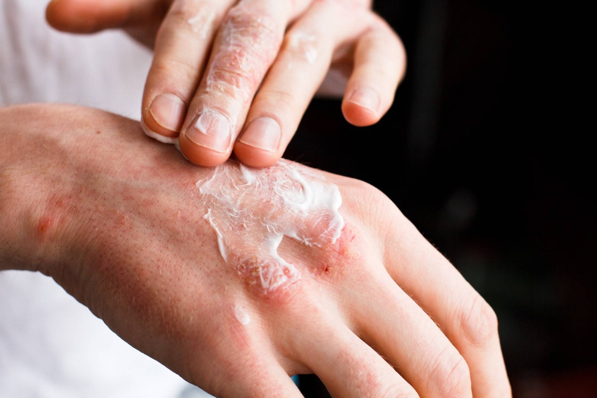 Сухой дерматит – заболевание, вызванное чрезмерной сухостью кожи