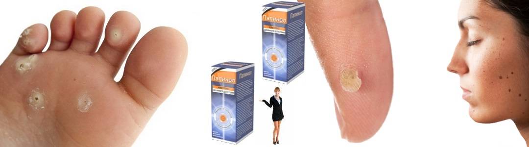 Шипица на ноге: специфика недуга и популярные способы лечения