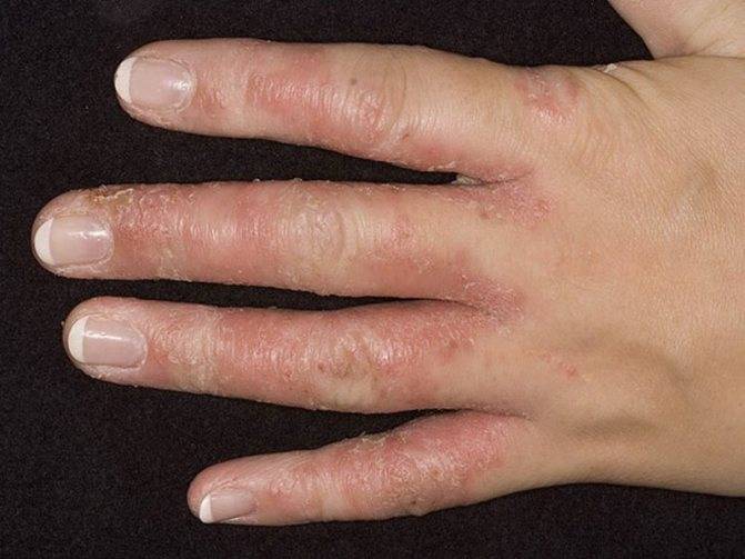 Экзема на пальцах рук и ног: причины возникновения, симптомы и методы лечения