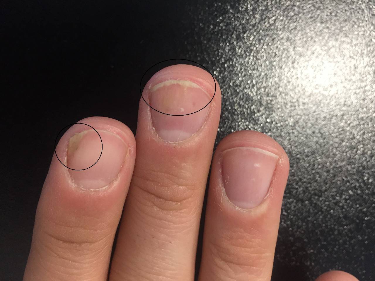 Причины ребристых ногтей на руках – почему ногти в полосочку и как это лечить
