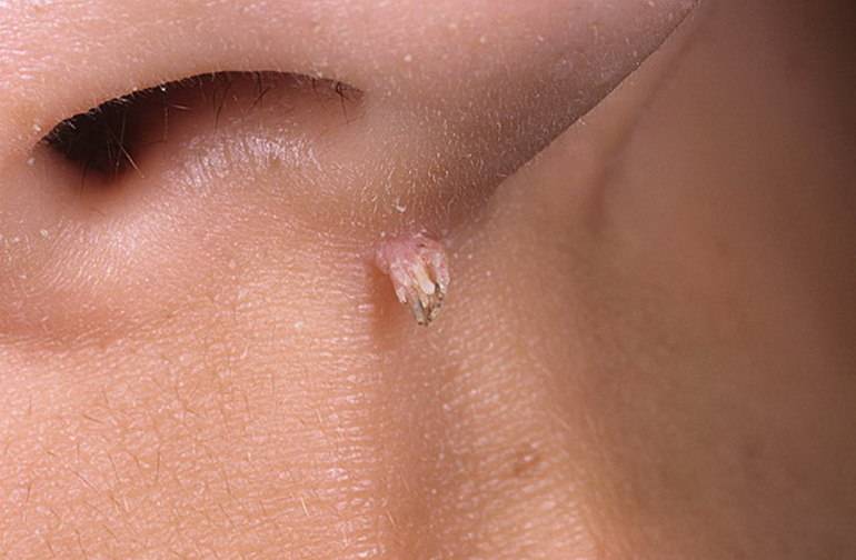 Почему появляются папилломы на половых губах? как их распознать и устранить? онкологические риски