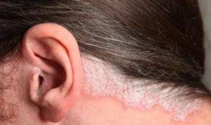Почему в ушах появляется перхоть и зуд: причины и лечение