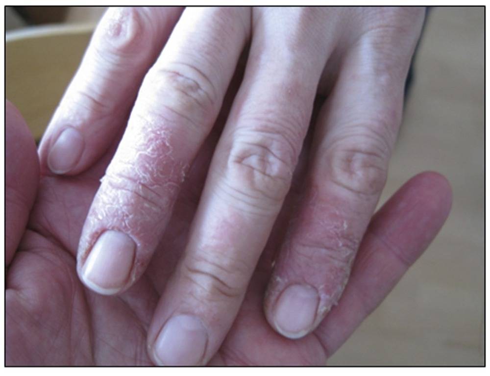 Экзема ногтей ног и рук: причины, признаки и лечение + фото