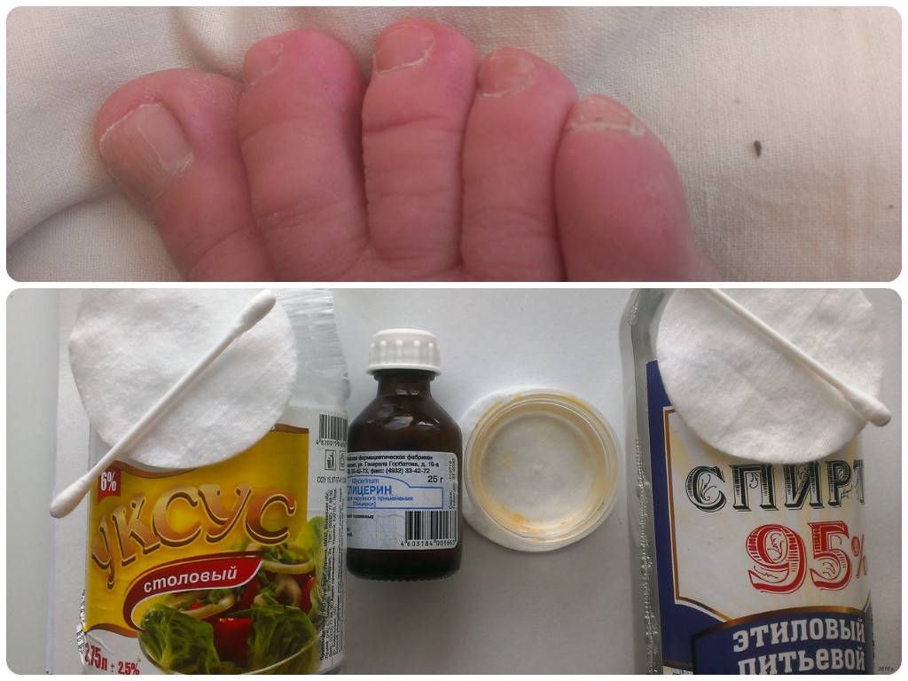 Быстрые и эффективные способы диагностики и лечения грибка ногтей на руках