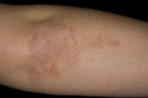 Болезнь дюринга (герпетиформный дерматит): причины, симптомы, лечение