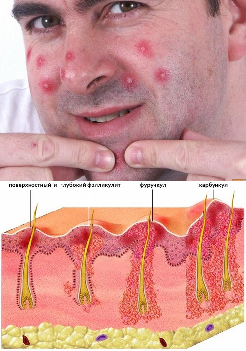Фурункул на носу: причины развития, как избавиться от чирья и лечить гнойник, симптомы и возможные осложнения