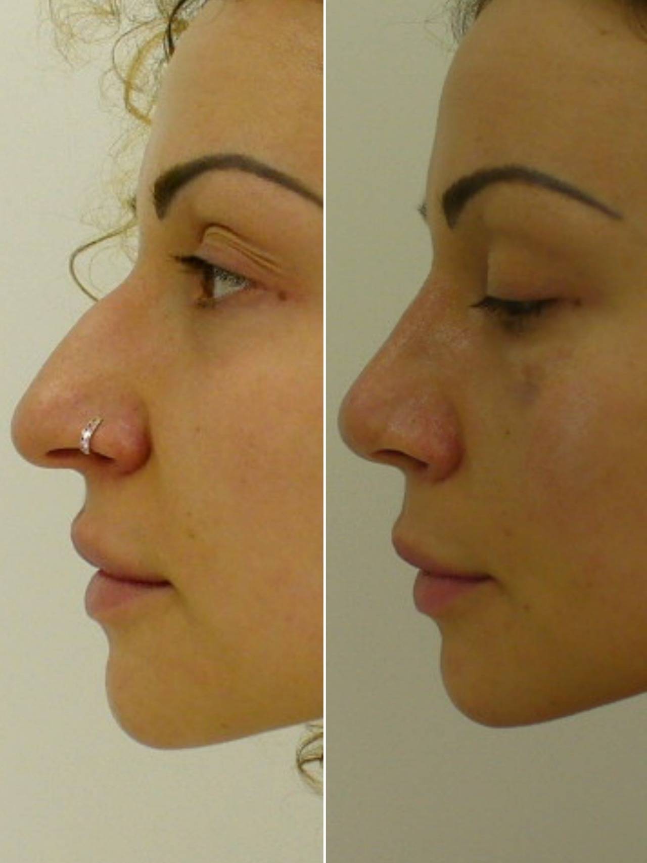 Клиника нос операция