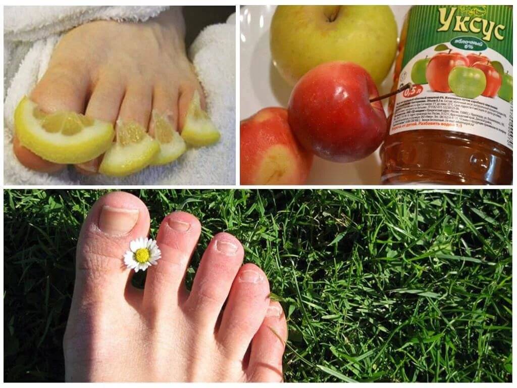 Как быстро вылечить грибок ногтей на ногах - рецептами народной медицины и лекарственными препаратами