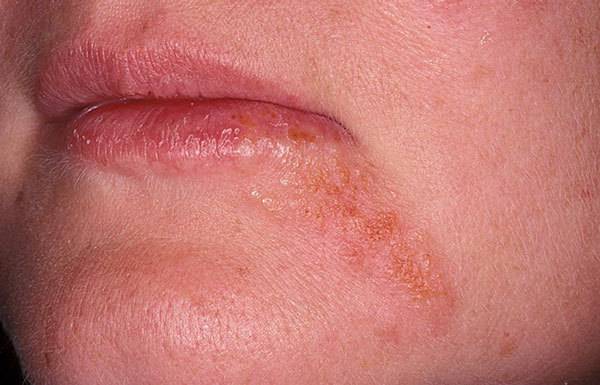 Периоральный дерматит на лице: лечение народными средствами и лекарственными препаратами