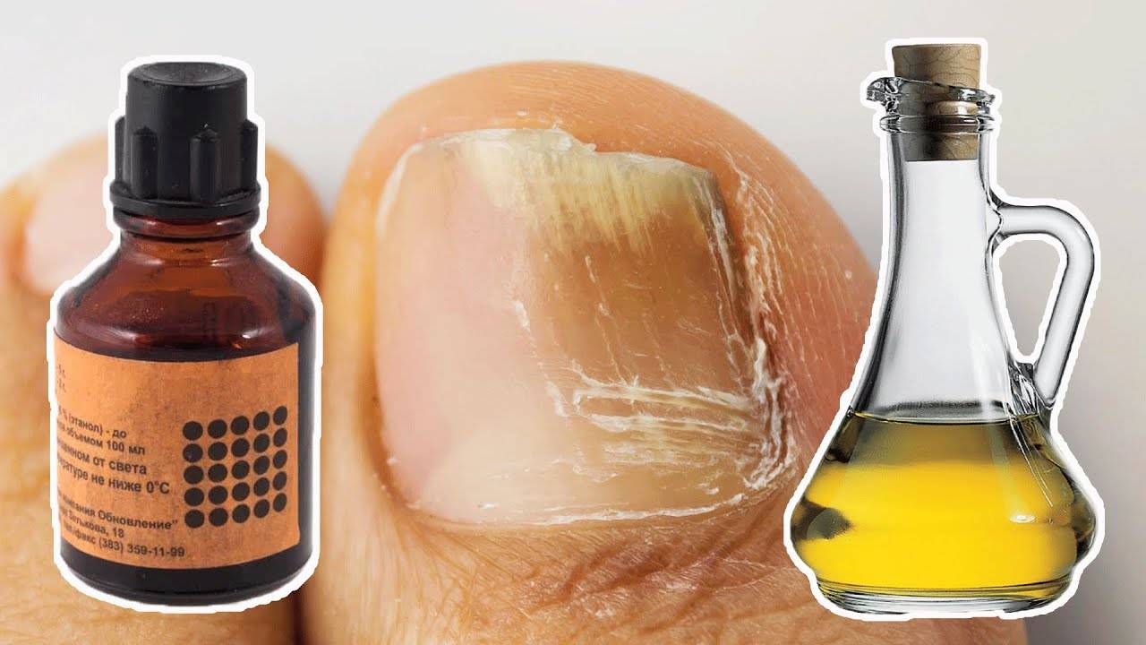 Как быстро вылечить грибок ногтей на ногах в домашних условия медикаментозными и народными средствами