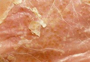 Пустулёзный псориаз — тяжёлая форма чешуйчатого лишая
