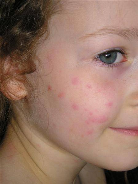 Крапивница у детей (27 фото): симптомы и лечение – чем лечить в домашних условиях аллергические высыпания на теле и лице, профилактика