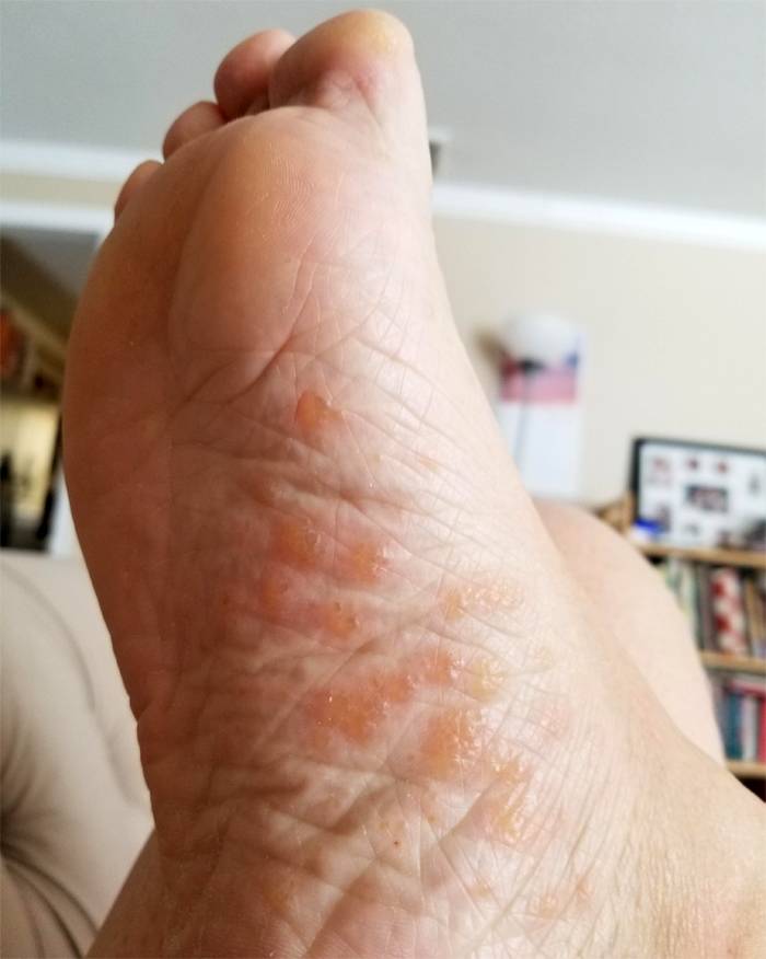 Экзема грибковая на ногах - лечим кожу
