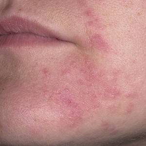 Почему возникает периоральный дерматит на коже лица, как с ним бороться?