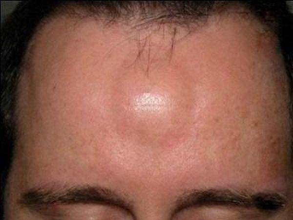 Фурункул на лице - как лечить - причины появления