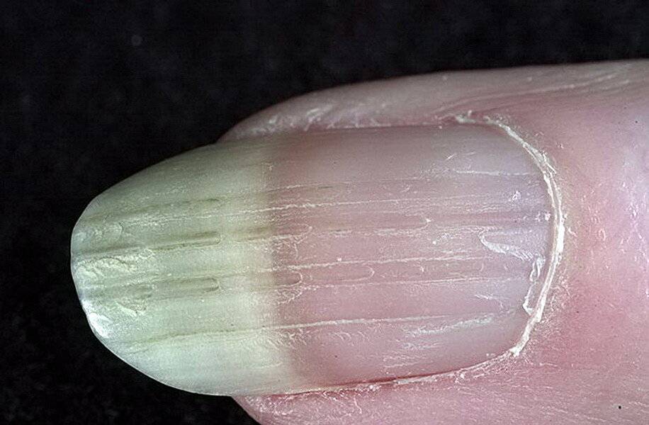 О чем говорят волнистые и бугристые ногти?