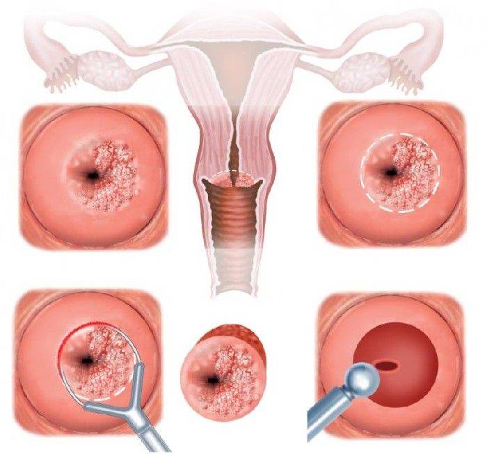 Впч-патология: эффективное лечение инфекции у женщин