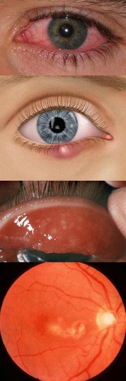 Чирей на глазу: лечение и как избавиться от фурункула
