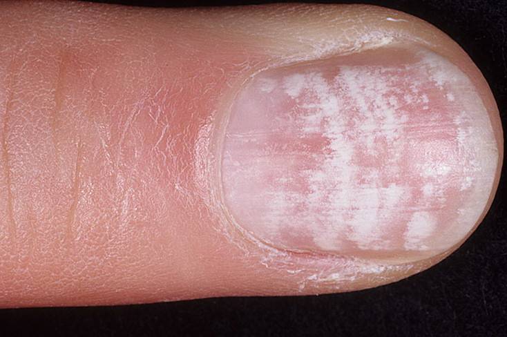 Экзема на ногтях рук — клинические проявления, диагностика, лечение. экзема ногтей рук: причины появления и лечение болезни