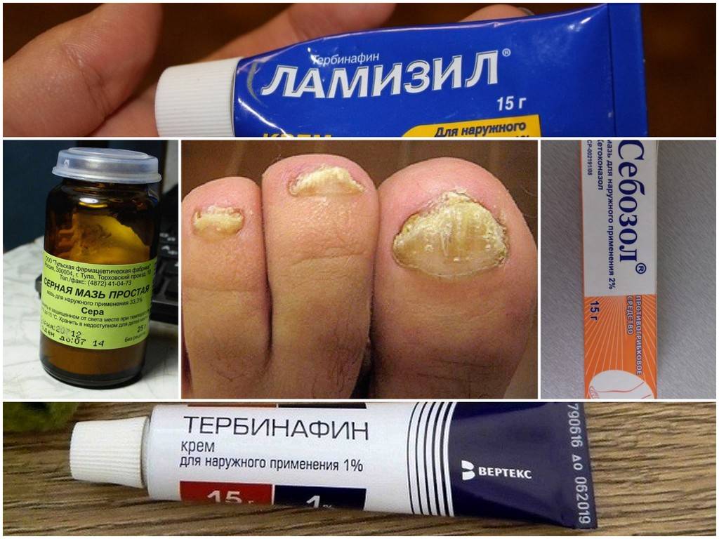 Препараты для лечение грибка ногтей: эффективные и недорогие. цены и отзывы людей