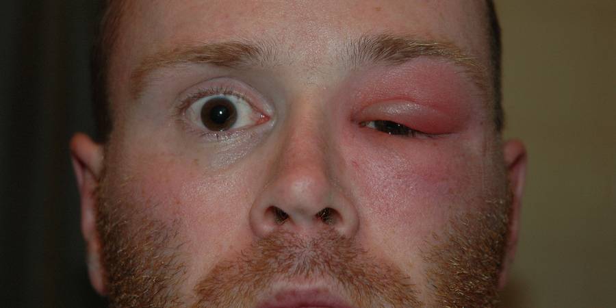 Общие сведения о фурункуле на глазу. чирей на глазу: причины, симптомы, методы лечения