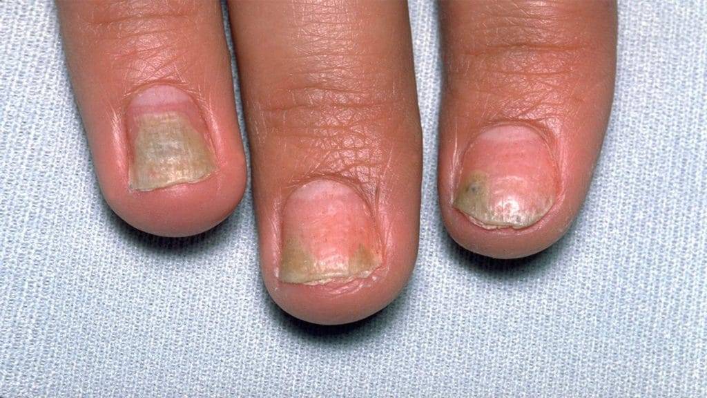 Экзема ногтей чем лечить - ваша кожа