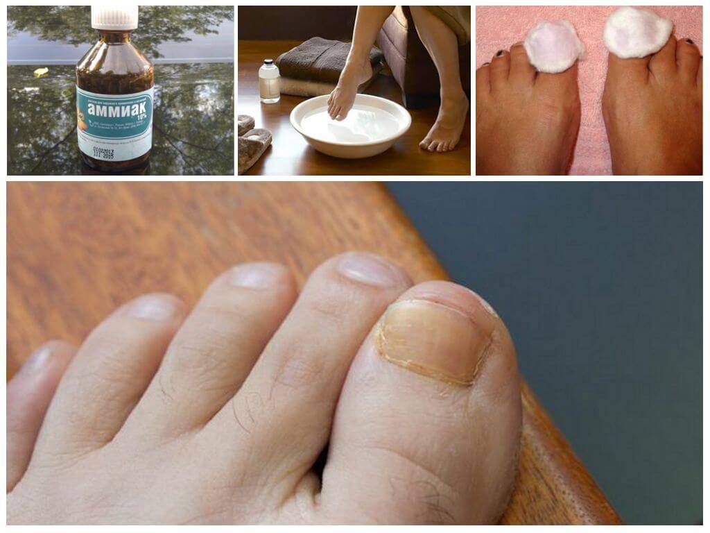 Как избавиться от грибка ногтей в домашних условиях. методы