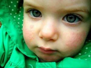 Крапивница у детей: симптомы, причины и лечение