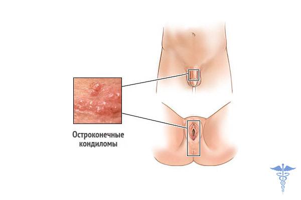 Генитальных папилломы на половых органах: доброкачественные и трансформирующиеся, впч у мужчин и женщин