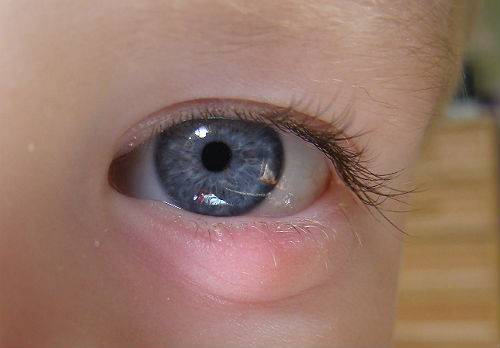 Как и чем лечить чирей на глазу у взрослых и детей oculistic.ru
как и чем лечить чирей на глазу у взрослых и детей
