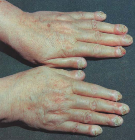 Тяжёлая форма хронического заболевания кожи — пустулёзный псориаз