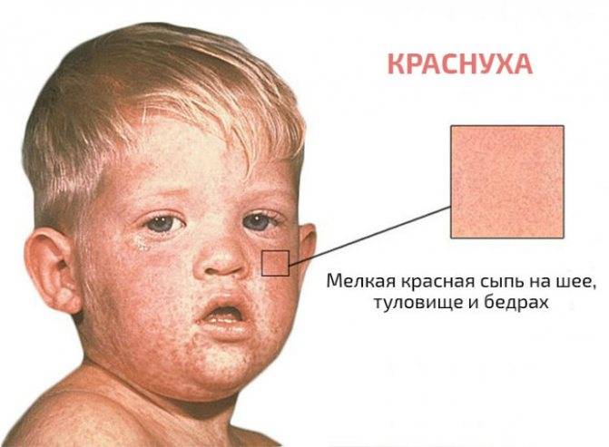 Инфекционный (вирусный) дерматит: причины, симптомы, фото, лечение