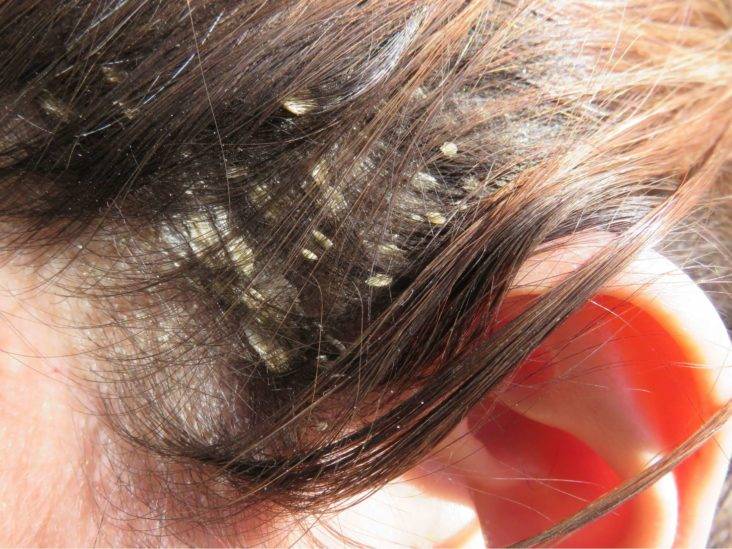 Перхоть на коже головы: причины и виды налёта, лечение и профилактика