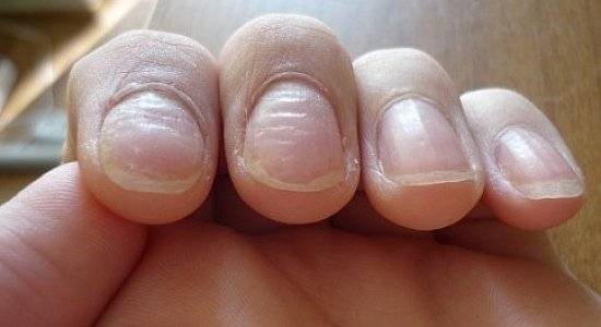 Какой диагноз можно поставить по ногтям?