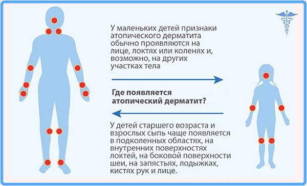 Симптомы вирусного дерматита и особенности его лечения
