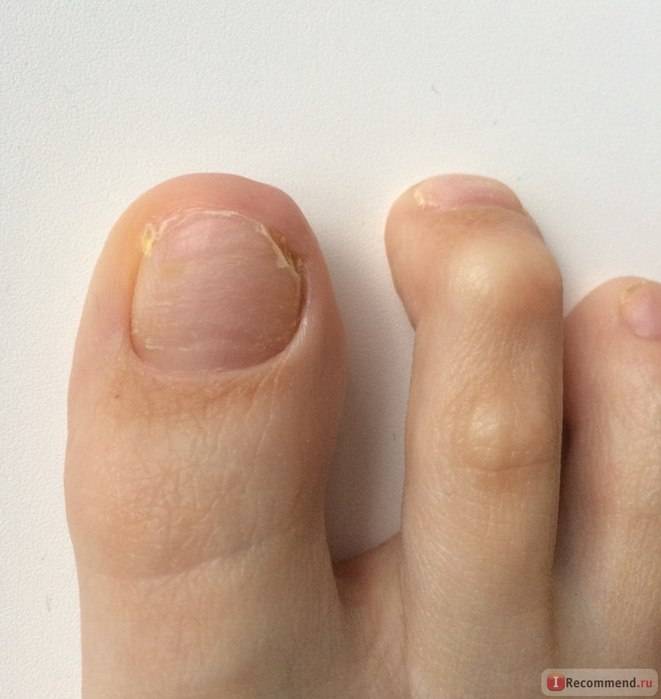 Грибок на пальцах ног: фото, причины, симптомы и лечение - топ-16 .