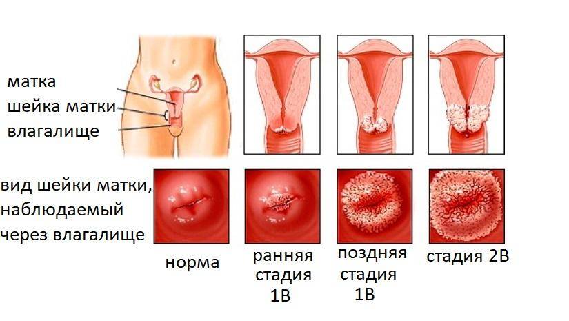 Вирус папилломы человека у женщин в гинекологии: что такое впч, симптомы и лечение