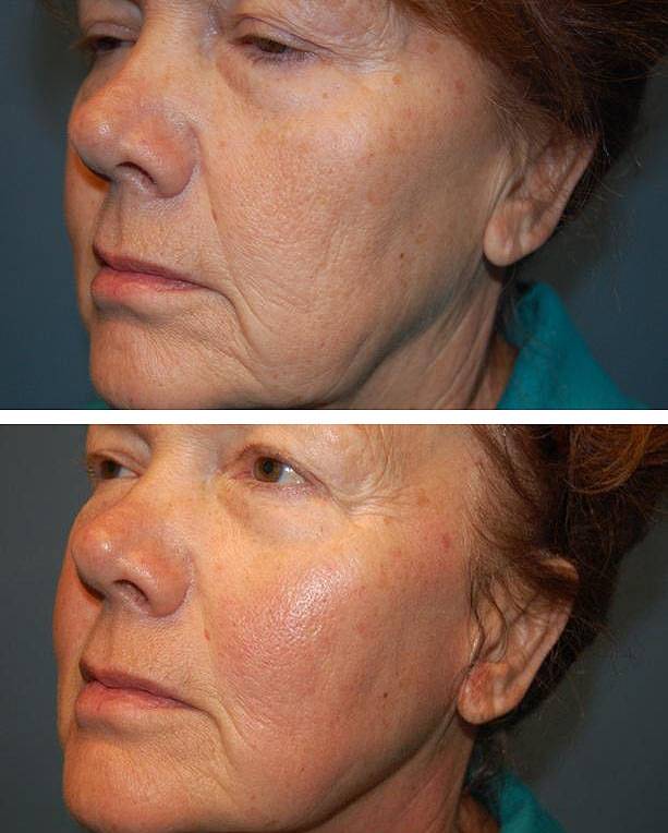 Процедура термаж (rf) кожи лица, век, глаз, тела, лифтинг и омоложение, результат до и после