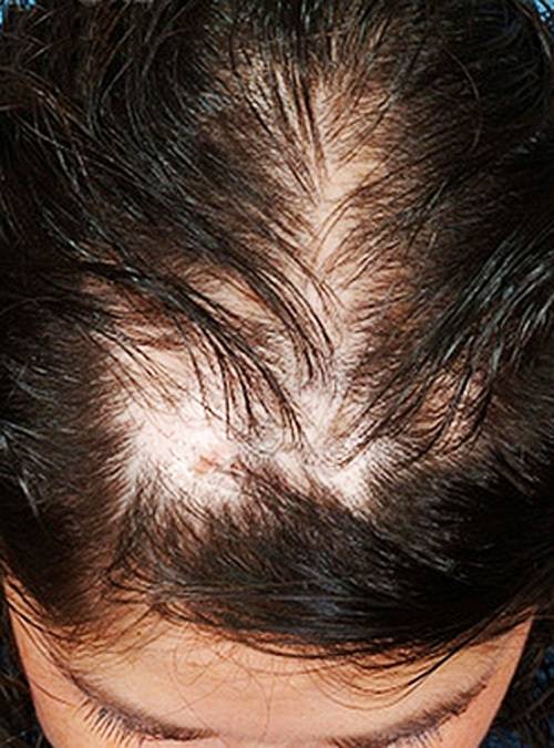 Выпадение волос головы причина лечение. Очаговая алопеция офиазис. Диффузная гнездная алопеция. Очаговая и диффузная алопеция.