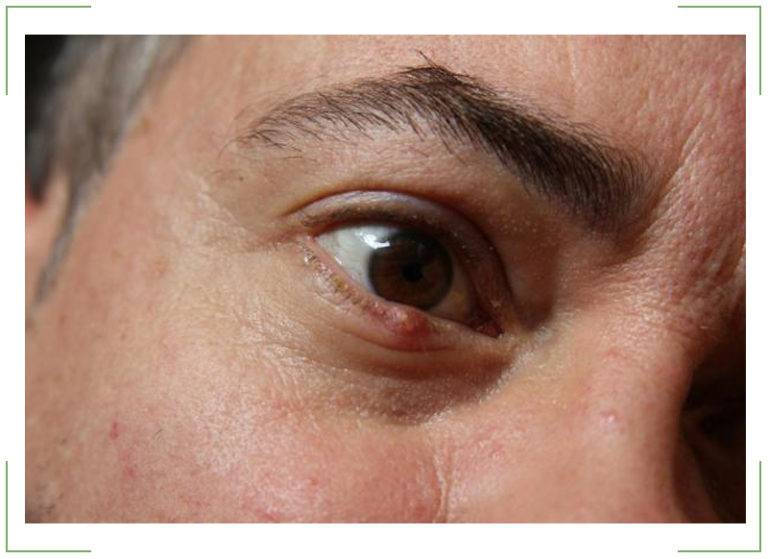 Фурункул на глазу у ребенка или взрослого - причины появления и стадии развития, методы лечения, профилактика