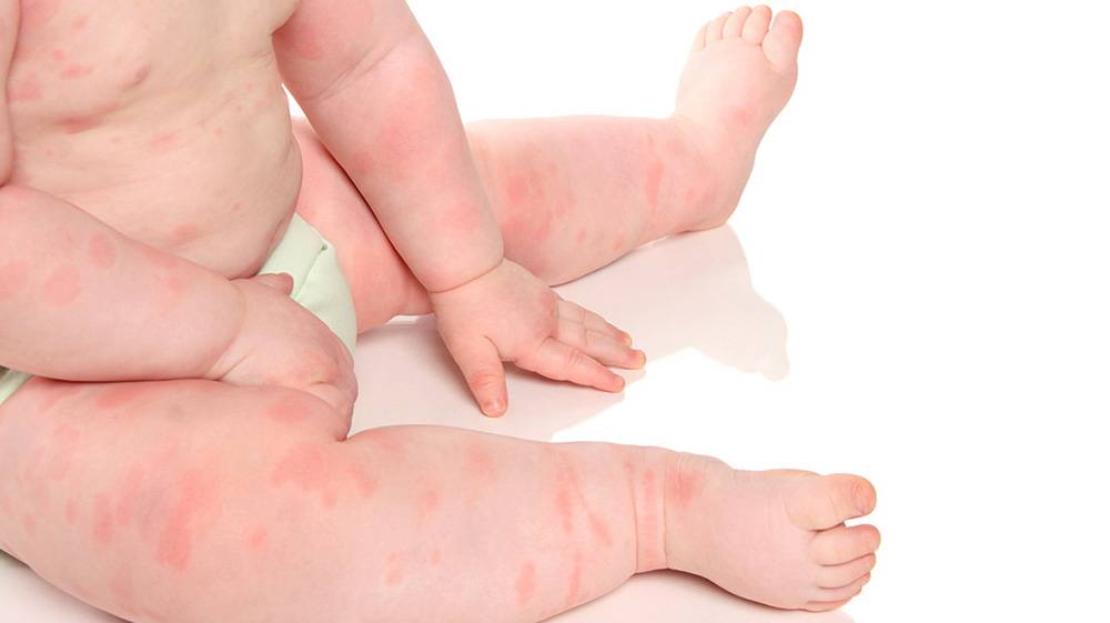 Аллергическая крапивница у детей: симптомы, лечение, профилактика и фото