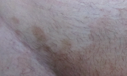 Симптоматика лишая в паху у мужчин: лечение кожных недостатков в интимной зоне