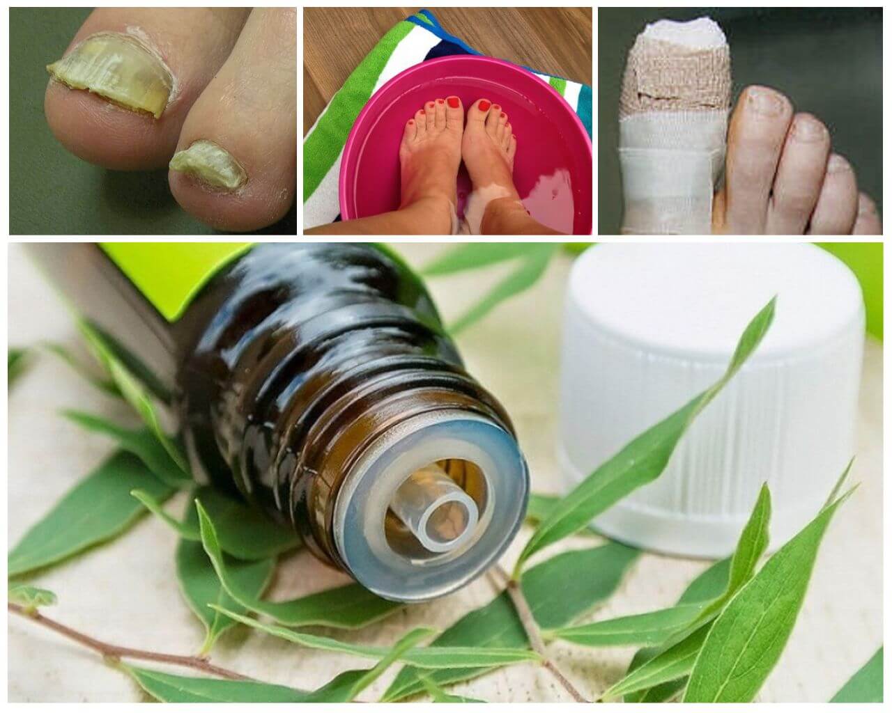 Масло чайного дерева от грибка ногтей: применение эфирного масла для лечения грибка на пальцах рук и ног, отзывы